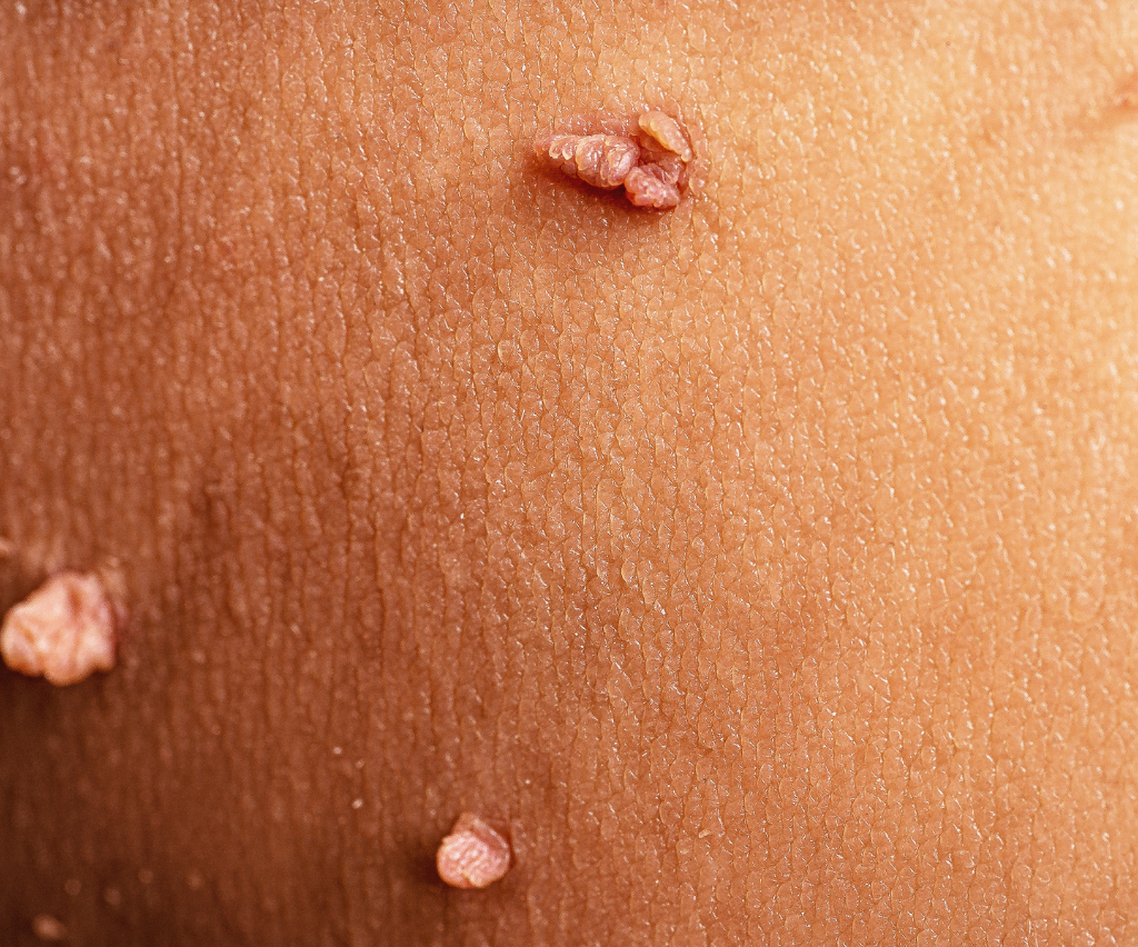 Warts Removal